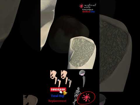 Total Hip Replacement: Arthroplasty Surgery Explained | Medical Arts video thumbnail