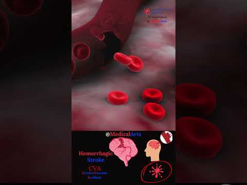 Hemorrhagic Stroke: What Happens in the Brain? video thumbnail