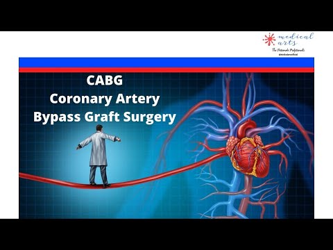 Coronary Artery Bypass Grafting (CABG): Surgery Explained | Medical Arts video thumbnail