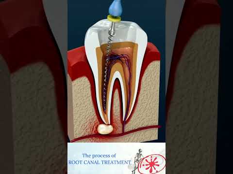 Root Canal Treatment: The Procedure Explained video thumbnail