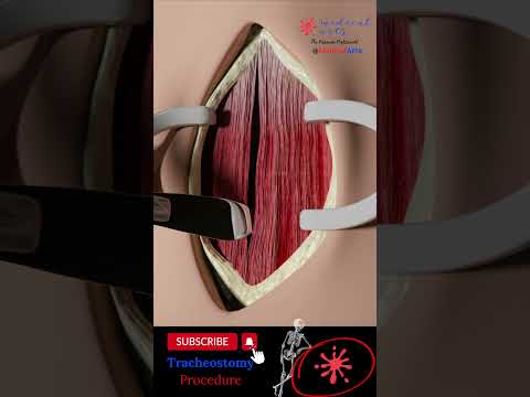 Tracheotomy and Tracheostomy: Airway Procedure Explained | Medical Arts video thumbnail