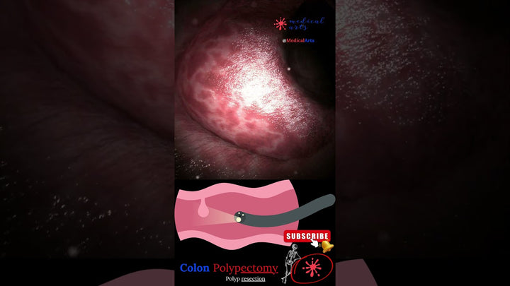 Coloscopy Colon Polyp Resection Polypectomy