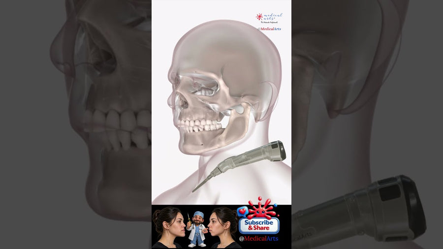 How Surgeons Fix a Receding Jaw #overbite #medicalanimation