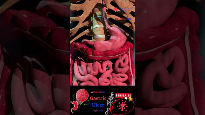 Stomach Ulcer ◑ Peptic Ulcer ● H.Pylori ◒ Medical Animations 3d ◐ Medical Arts