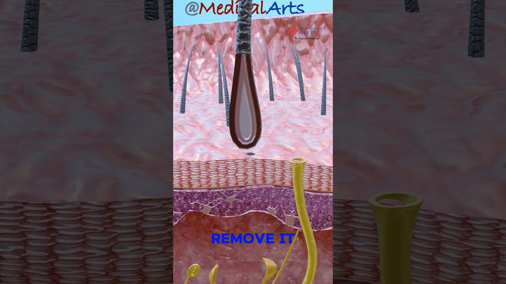 Blackhead video ⚫ Blackhead formation #dermatology