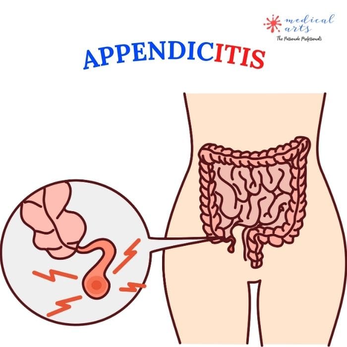 APPENDICITIS OVERVIEW: Causes, Symptoms, & Treatment