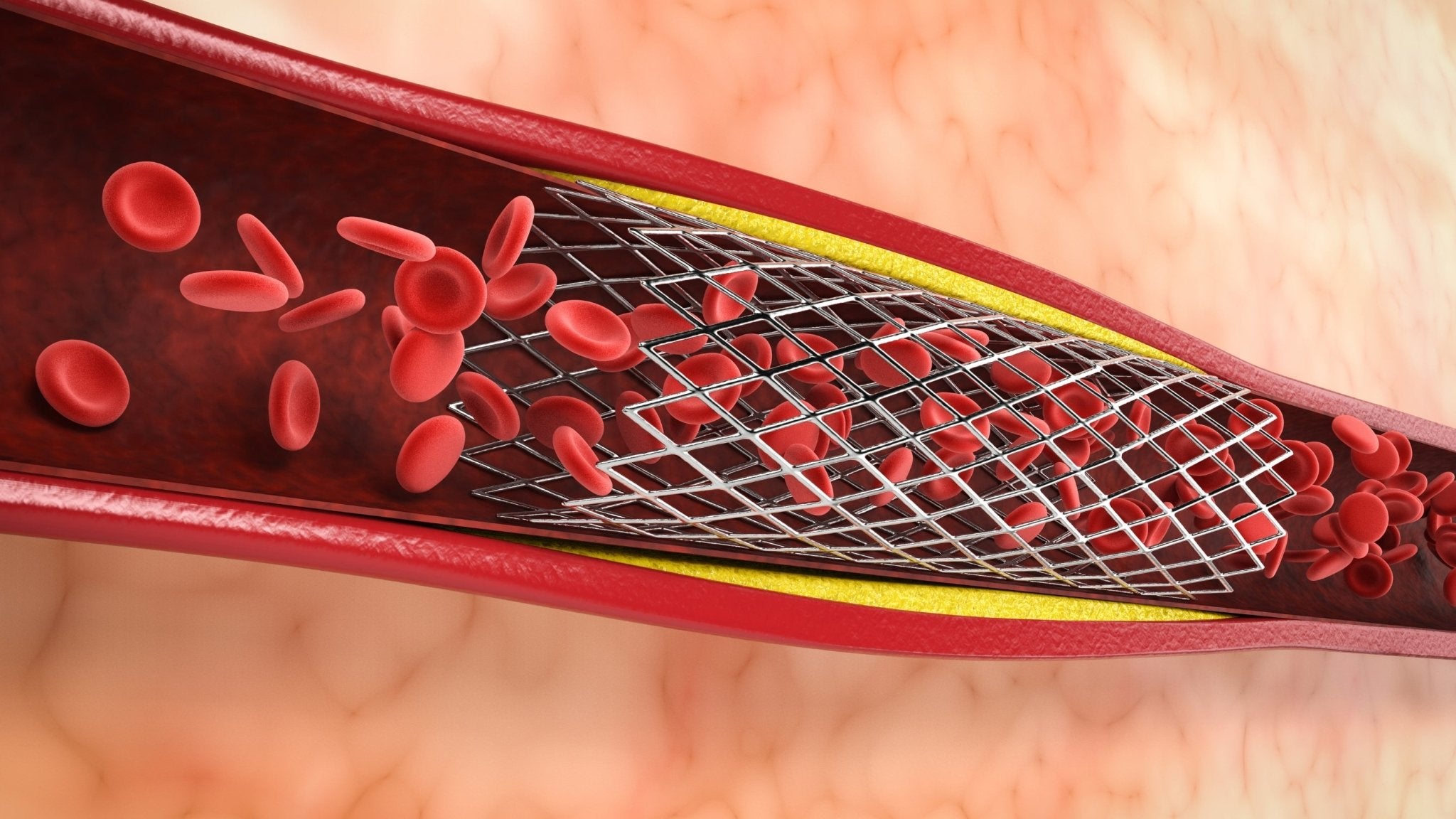Heart Attack (Myocardial Infarction) || Angioplasty (PCI)