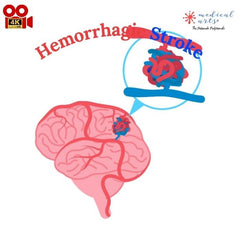 Hemorrhagic Stroke - CVA *Video included* - Medical Arts Shop