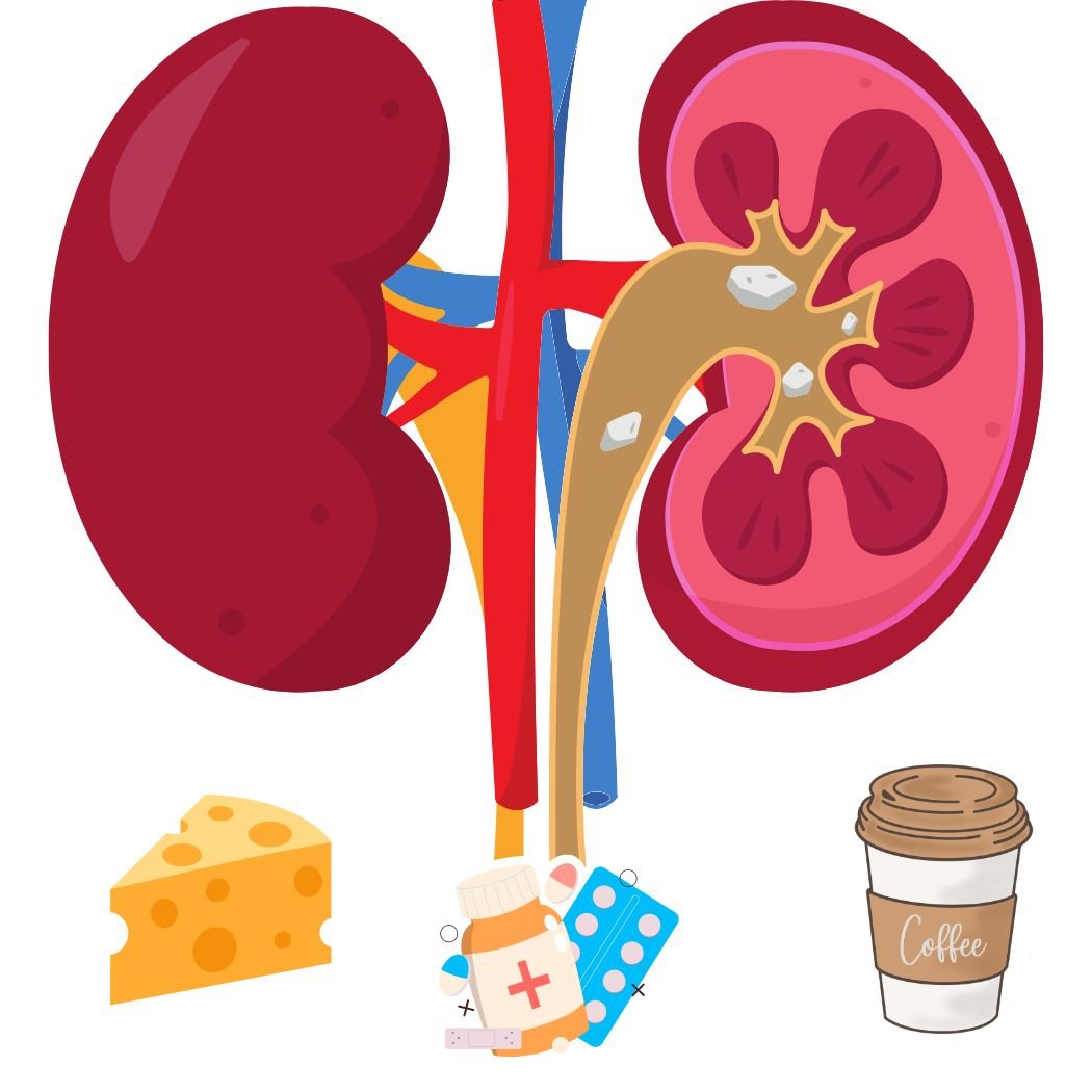 How to prevent KIDNEY STONES