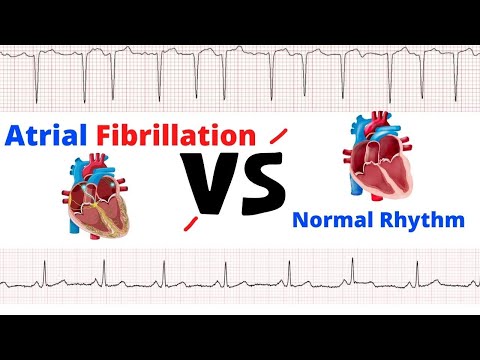 Atrial Fibrillation vs Normal Heart Rhythm: ECG Visual Guide | Medical Arts video thumbnail