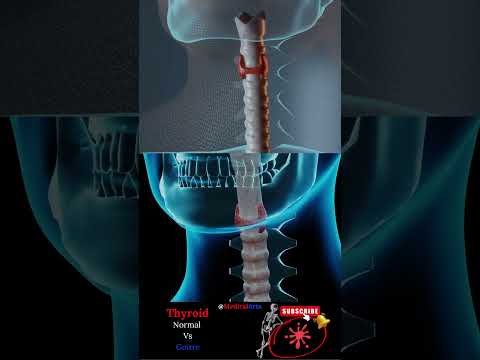 Goiter: Understanding Thyroid Enlargement video thumbnail
