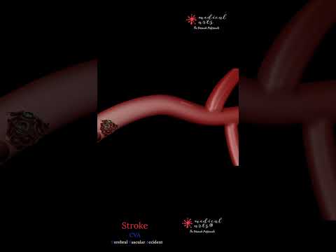 Ischemic Stroke Explained: When a Blood Clot Blocks the Brain | Medical Arts video thumbnail