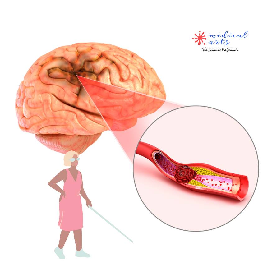 Ischemic Stroke By A Blood Clot | CVA | Cerebral Vascular Accident.