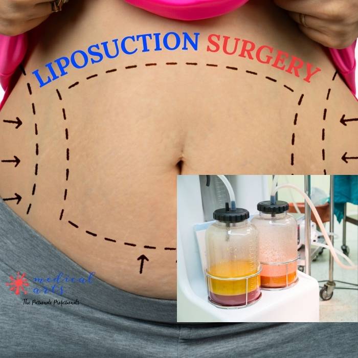 LIPOSUCTION • Weight Loss Surgery • Cosmetic Surgery #weightloss