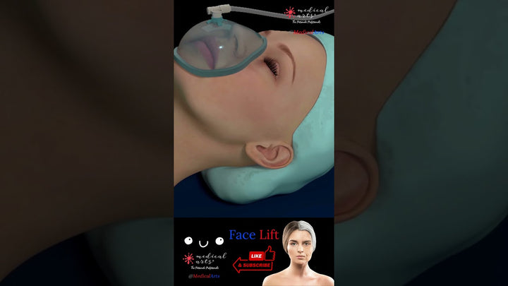 Face Lift Surgery - Medical Arts Animations