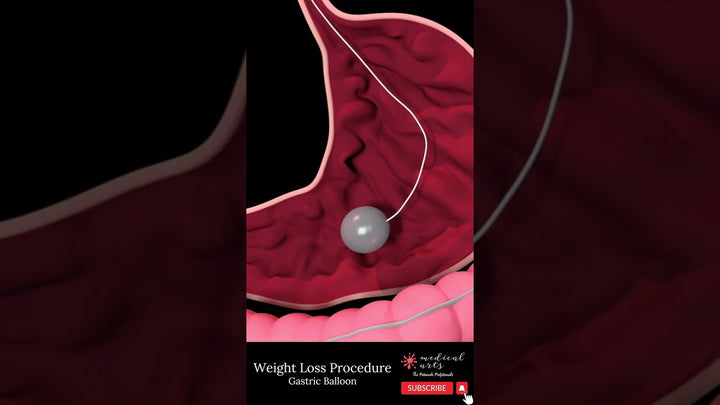GASTRIC BALLOON [] bariatric surgery [] weight loss surgery #shorts