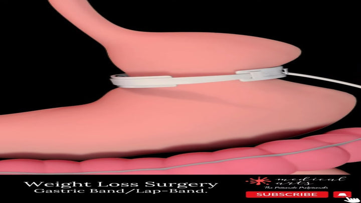 WEIGHT LOSS SURGERY gastric band lap-band #shorts