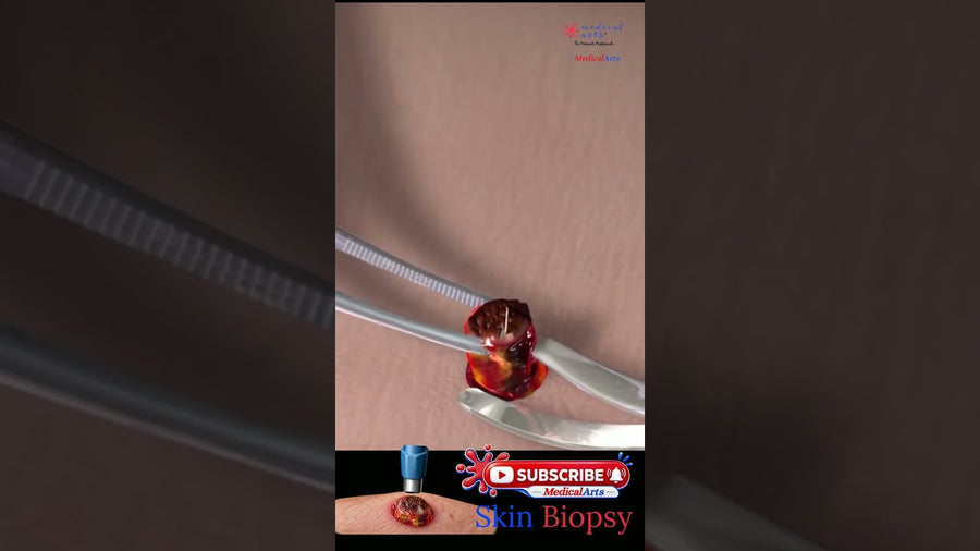 Suspicious Skin Lesion? Here’s How Doctors test It #medicalanimation