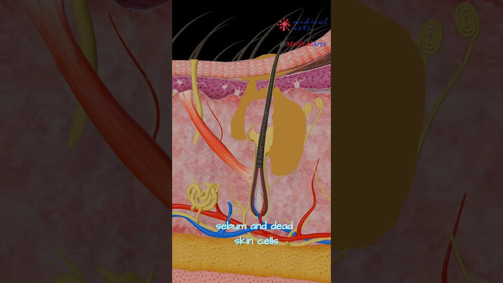 What's inside a pimple? How does acne develop? Medical Arts Animation