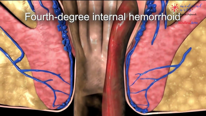 What does each stage of hemorrhoid look like?