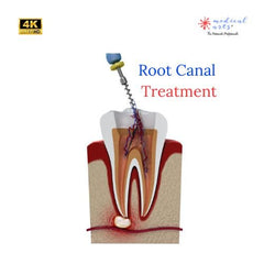 Process of Root Canal Treatment - Video - Medical Arts Shop
