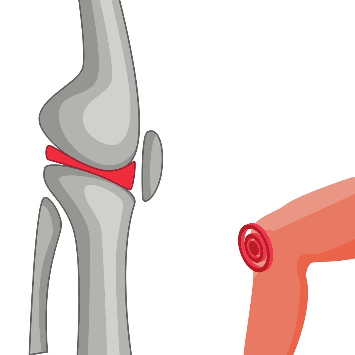 Total Knee Replacement - All The Journey