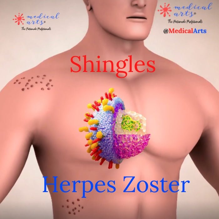 Understanding Shingles: The Varicella Herpes Zoster Virus 📽 video included